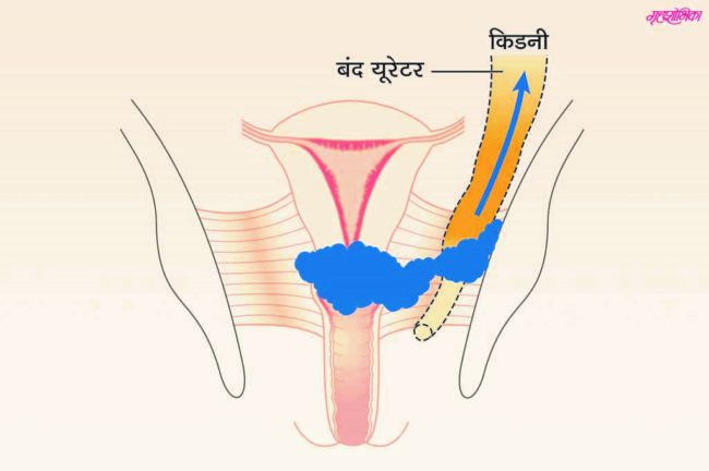 सर्व्हाइकल कॅन्सरपासून कसे वाचाल