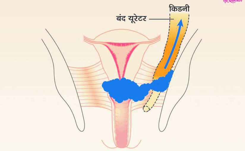 सर्व्हाइकल कॅन्सरपासून कसे वाचाल