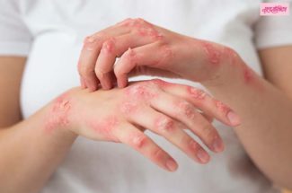 पावसाळ्यात त्वचेची अ‍ॅलर्जी टाळणे गरजेचे आहे, कसे ते येथे जाणून घ्या