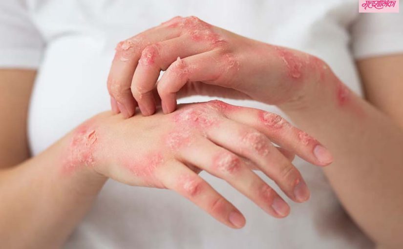 पावसाळ्यात त्वचेची अ‍ॅलर्जी टाळणे गरजेचे आहे, कसे ते येथे जाणून घ्या