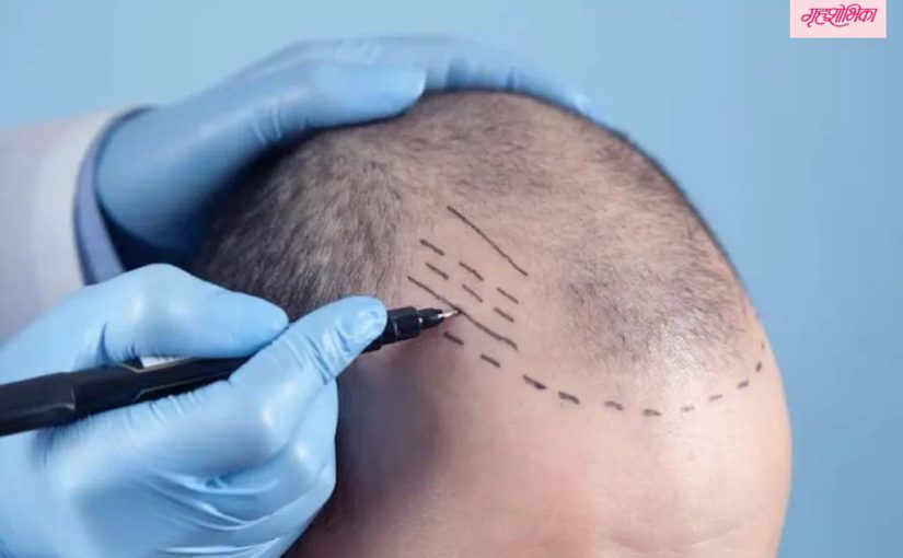 केस प्रत्यारोपण खरोखर सुरक्षित आहे का? ही शस्त्रक्रिया कधी धोकादायक असू शकते हे जाणून घ्या